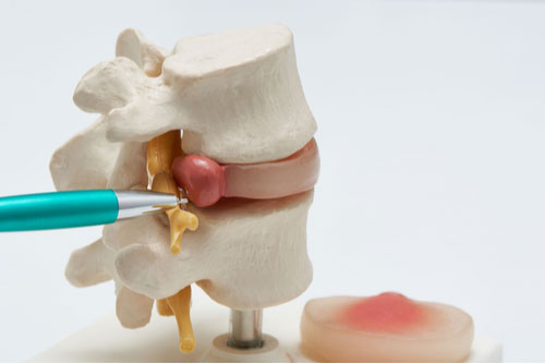 Concept of Naples herniated disc treatment, model of herniated disc