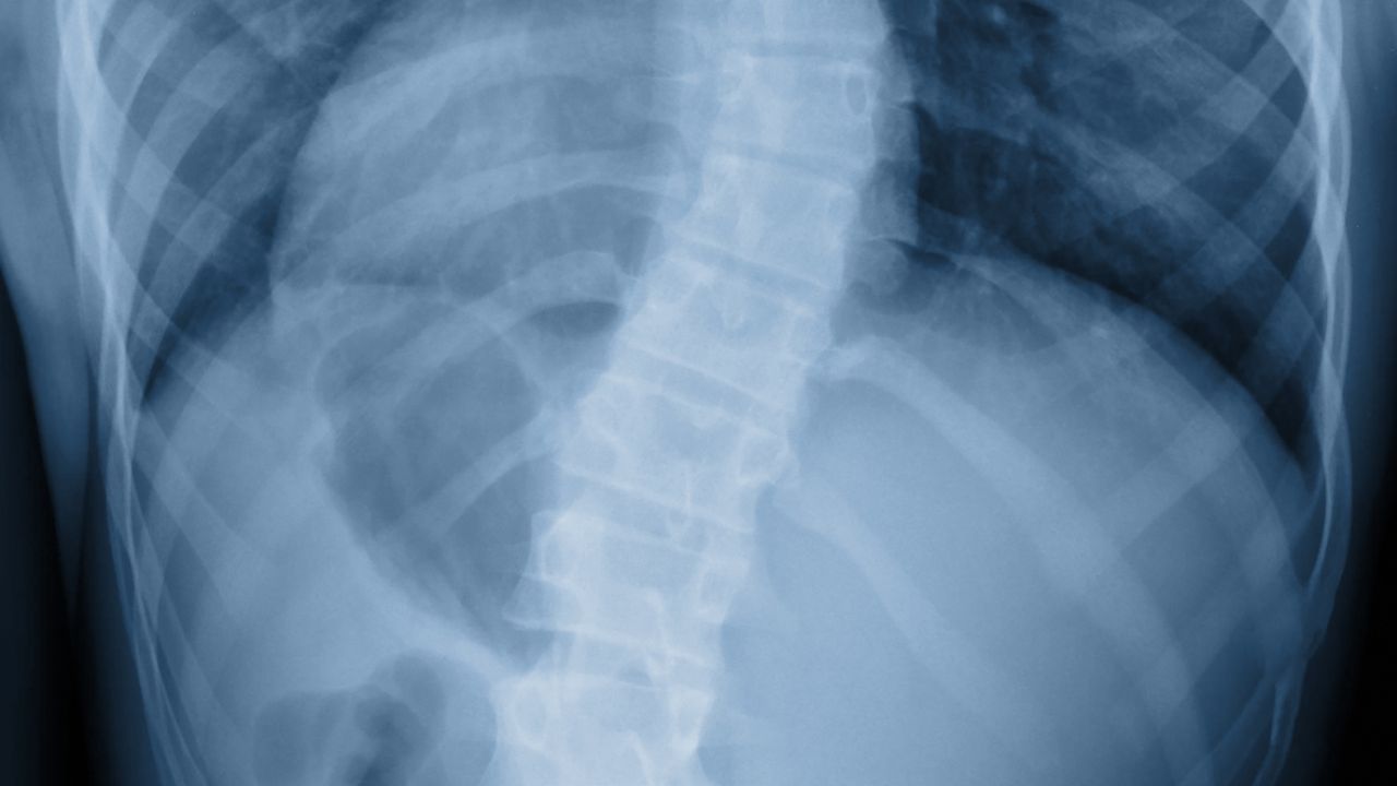 an X-ray image of a spine with Scoliosis